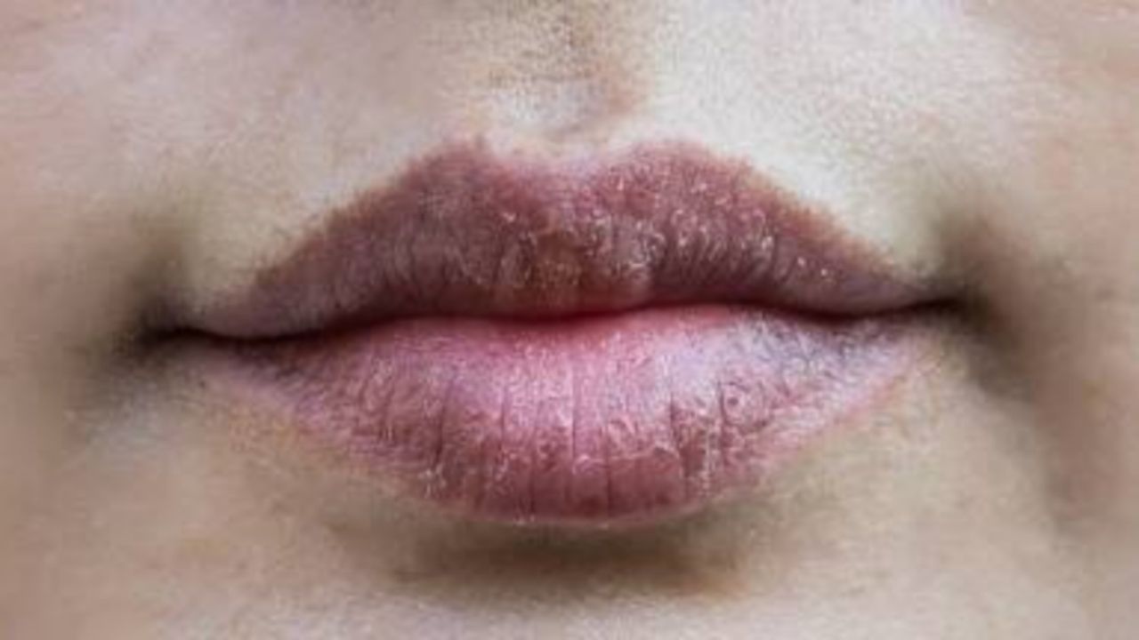 Lip Care Tips: শীতকালে ঠোঁট ফাটার সমস্যা ঘরোয়া উপায়ে যেভাবে দূর করবেন