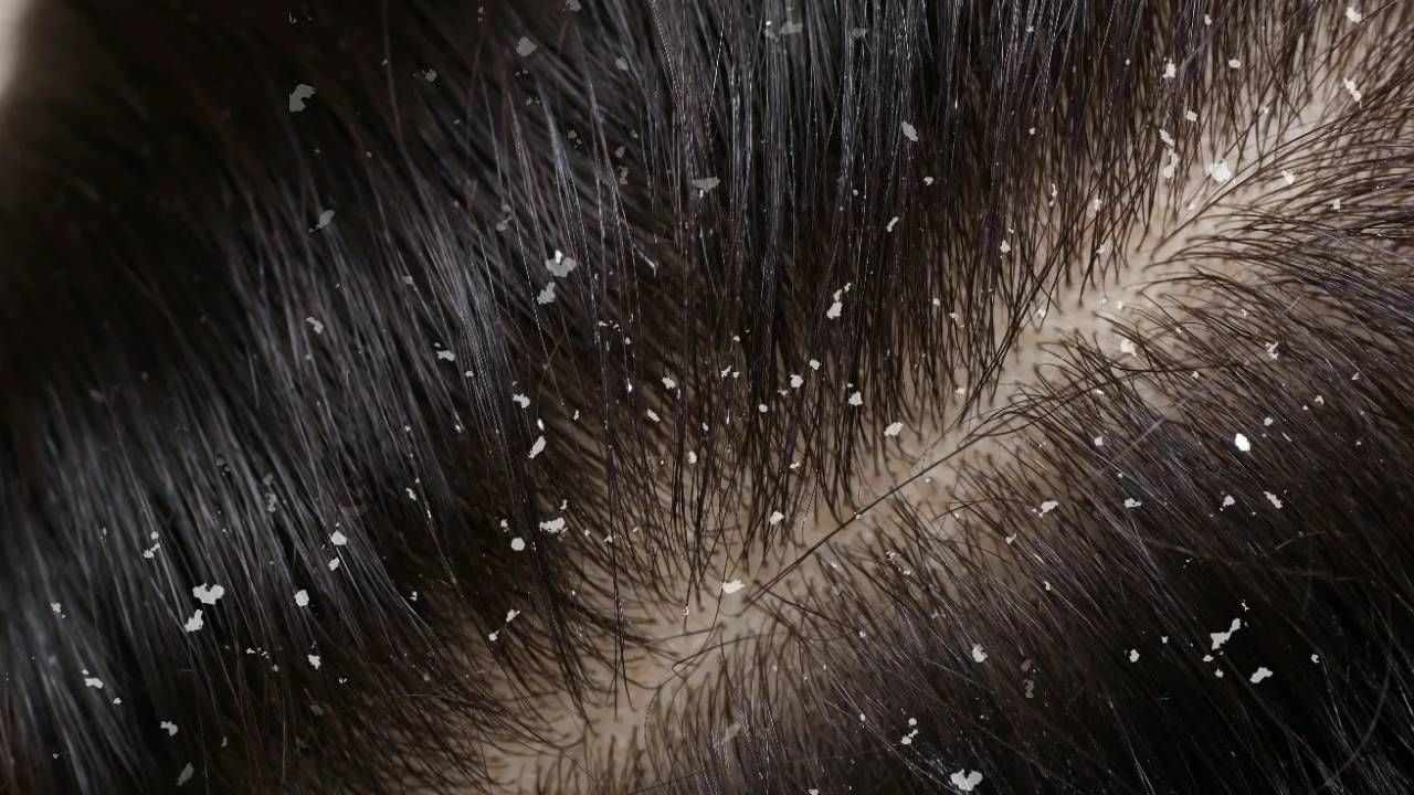Hair Care: খুশকির সমস্যায় জর্জরিত? বাড়িতে নারকেল তেল থাকলেই করে ফেলুন সমাধান